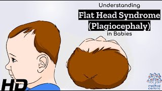 Flat Head Syndrome Explained Causes Symptoms and Solutions [upl. by Drol899]