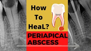 Case of PERIAPICAL ABSCESS Dr Sunil kumar Dental ji [upl. by Liuqnoj]