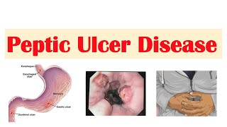 Peptic Ulcer Disease Gastric vs Duodenal Ulcers  Causes Symptoms Diagnosis Treatment [upl. by Munroe]