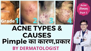 Acne Types and Causes In Hindi  Acne Types with Pictures  Pimple Ke Prakar  Dr Sunil [upl. by Lockwood]