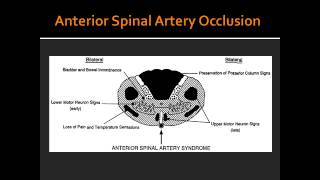 Complete Occlusion of Anterior Spinal Artery [upl. by Nayhr]