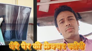 Fracture Story Of my tibia Fibula SurvivalWithNitin jharaayurveda0007 ChirayuHospital vlog [upl. by Cis]