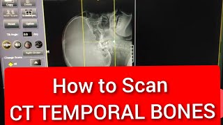 Temporal Bones CT scan Protocol Positioning amp Planning [upl. by Demetrius]