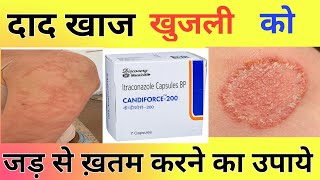 Candiforce 200 Capsule Uses  Khujli Ka Permanent Ilaj [upl. by Pantia]