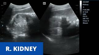 Acute Pyelonephritis  Ultrasound Case [upl. by Zil]