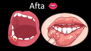 👄 Aftas  Cavidad oral  Cabeza y Cuello  Patología [upl. by Nahtannhoj396]