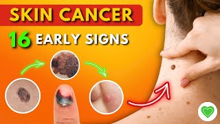 16 Early Signs of Skin Cancer You Should Never Ignore  Melanoma  Skin Cancer Symptoms [upl. by Natalya404]