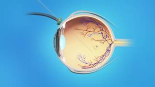 Macular Hole Vitrectomy Surgery [upl. by Melamie]