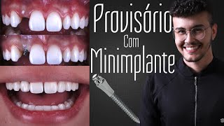 Dente provisório com Minimplante Ortodôntico Como fazer [upl. by Meredith949]