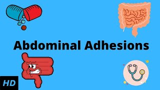 Abdominal Adhesions Causes Signs and Symptoms Diagnosis and Treatment [upl. by Triplett]