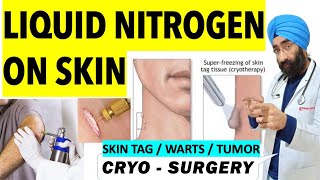 Cryotherapy  Super Freezing Skin tags Warts or Tumor with Liquid Nitrogen  Cryosurgery [upl. by Eimaj119]