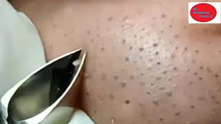 How To Removal Blackheads And How To Get Rid of Blackhead 27 [upl. by Akvir]