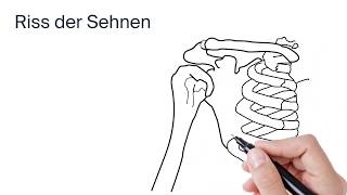 Behandlung einer Rotatorenmanschette by ATOS Kliniken [upl. by Reham]