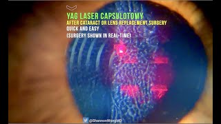 Everything you need to know about YAG LASER Capsulotomy in 30 seconds [upl. by Domenech117]