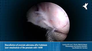 Morcellation of prostate adenoma after holmium laser enucleation of the prostate [upl. by Stormi]