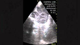 VSCAN Retroperitoneal lymphadenopathy Adenopatías retroperitoneales [upl. by Ayotas58]