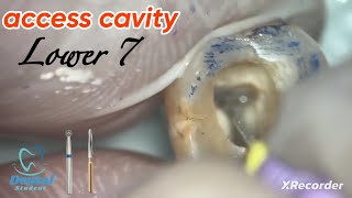 access cavity preparation for lower second molar Lower 7 [upl. by Ymarej914]