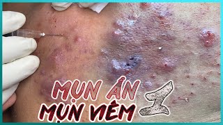 Big Cystic Acne Blackheads Extraction Blackheads amp Milia Whiteheads Removal Pimple Popping [upl. by Corwun]