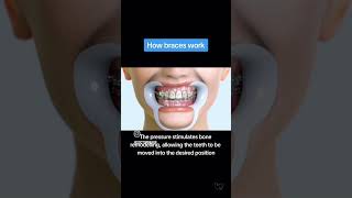 Orthodontic treatment dentaltreatment fixedorthodontictreatment [upl. by Nuhs110]