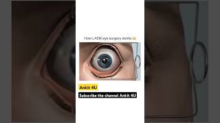 How Lasik Surgery works  Eye Surgery ytshorts shortvideo eye eyesurgery [upl. by Allare]