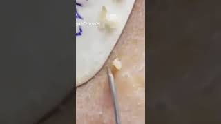 Pickel Ausdrücken Blackheads Mitesser Entfernung 🔴 56 [upl. by Millar]