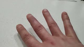 Mallet finger recovery after eleven weeks [upl. by Karp]