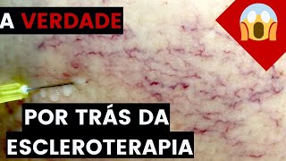 A VERDADE por trás da ESCLEROTERAPIA aplicação de VARIZES Não faça se você NÃO souber isso [upl. by Allicirp697]