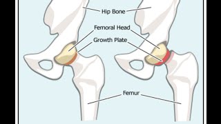 Slipped Capital Femoral Epiphysis SCFE [upl. by Stieglitz]