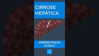 Cirrose hepática Apresentação clínica  Kenhub cirrose [upl. by Yrrol]