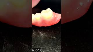 Prosthodontics insertion acetal rpd [upl. by Meredithe835]