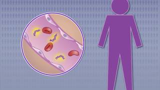 Detecting Nasopharyngeal Carcinoma in Asymptomatic Persons [upl. by Aicenra]