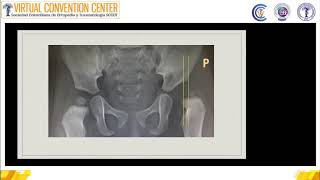 Webinar Radiología de la displasia de cadera un dolor de cabeza [upl. by Swift]