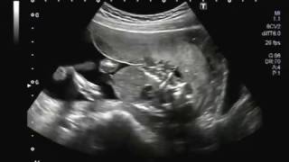 Ultrasound Video showing Acrania a rare lethal congenital anomaly [upl. by Lyndel]