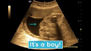 Ultrasound showing boy baby [upl. by Bohannon240]