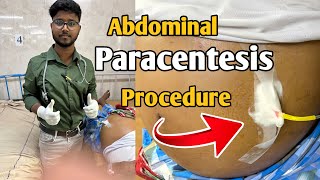 How I do abdominal paracentesis easily during internship after passing FMGE  Abdominal Tap [upl. by Kallman]