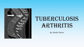 Ortho Tuberculosis arthritis  TB in joints spine TB gibbus deformity investigation treatment [upl. by Foote]