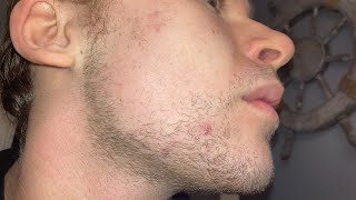 Minoxidil and Derma Roller Year 2 Week 29 [upl. by Leziar]