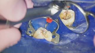 Endodontiste Hugo Setbon  Le retraitement endodontique [upl. by Atiras]