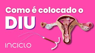 Como é Colocado o Diu  Como Funciona a Colocação do Diu [upl. by Ytsirc]