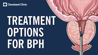 Treating Benign Prostatic Hyperplasia BPH [upl. by Leirrad]