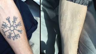 Amazing Laser Tattoo Removal Results [upl. by Radek]