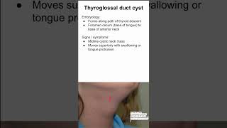 Thyroglossal duct cyst [upl. by Aicirtap196]