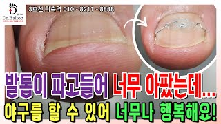 🔨파고드는 발톱🔨야구가 너무 좋은 어린 고객님의 발톱 😘 발톱 교정 후 신나게 야구하고 있답니다 발톱닥터 내성발톱 내성발톱교정 내성발톱관리 지축역 [upl. by Niwre485]