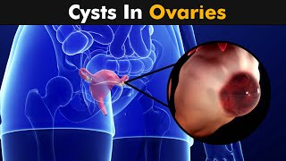 Ovarian Cysts  Types Causes and Symptoms UrduHindi [upl. by Aneeb]