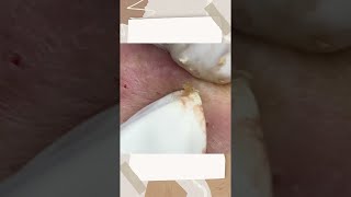 Big Cystic Acne Blackheads Extraction Blackheads amp Milia Whiteheads Removal Pimple Popping [upl. by Melville]