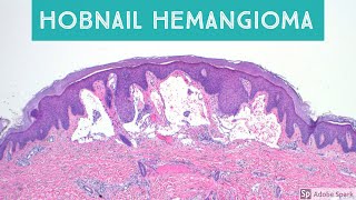 Hobnail Hemangioma Targetoid Hemosiderotic Hemangioma Retiform Hemangioendothelioma and Mimics [upl. by Nika]