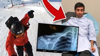 I BROKE MY COLLAR BONE  LIVE FOOTAGE [upl. by Piefer]