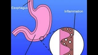 What is Gastritis [upl. by Adnarahs8]