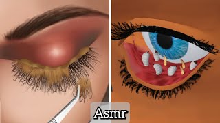 ASMR Why Fake Lashes  Extensions Are Dangerous  Eye Infection Due To Fake Lashes Asmr Treatment [upl. by Rica]