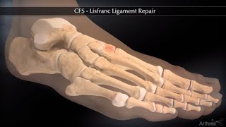 CFS Lisfranc Ligament Repair [upl. by Wilton]